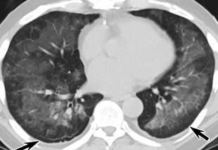 图1，抽了一年relx电子烟的肺部